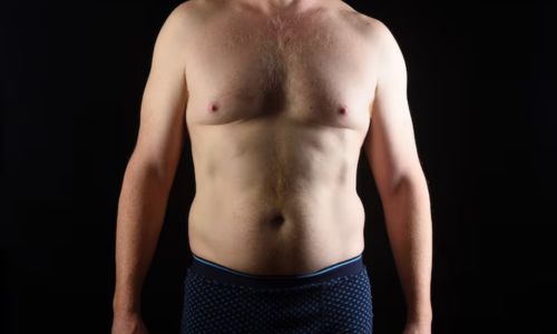 Gynecomastia Correction Surgery<br />
