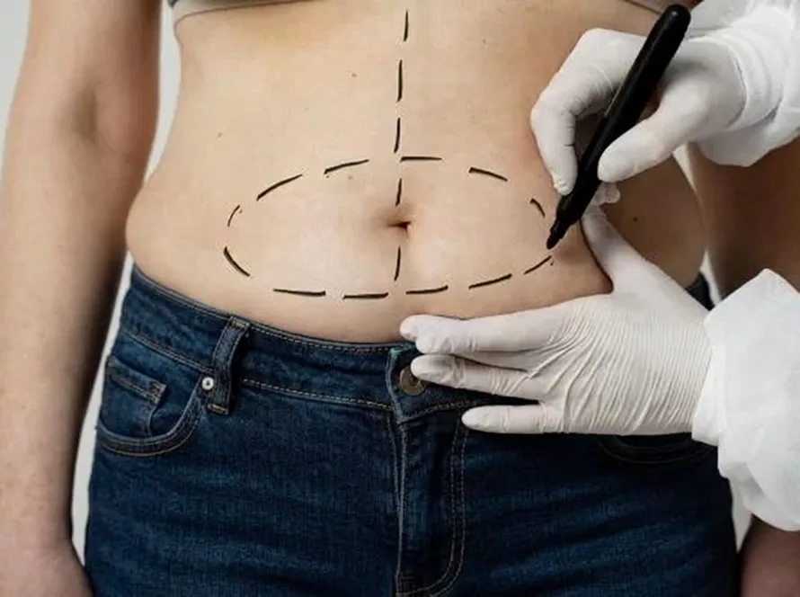 Body Contouring Surgery