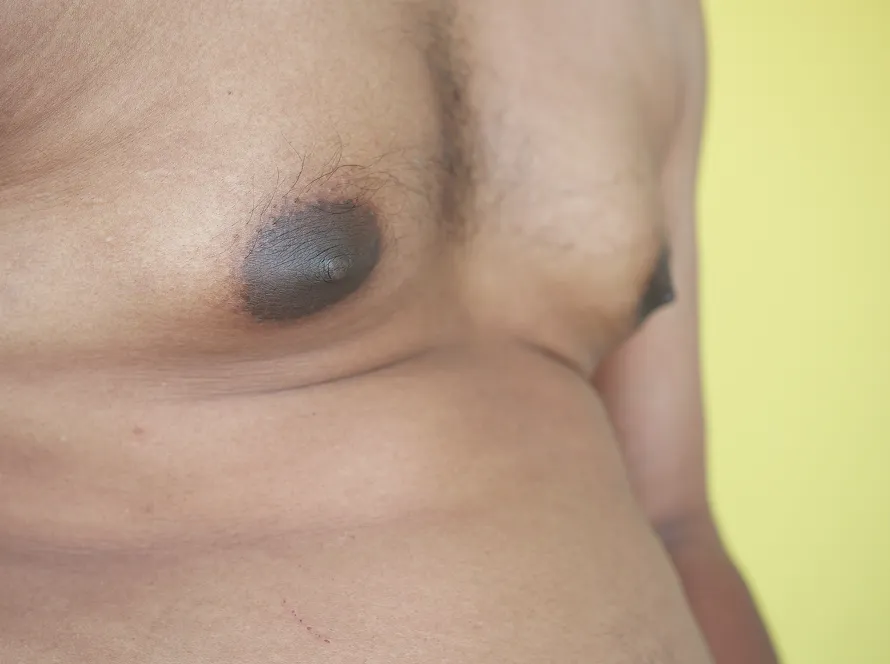 Gynecomastia (Male Chest Reduction Surgery)
